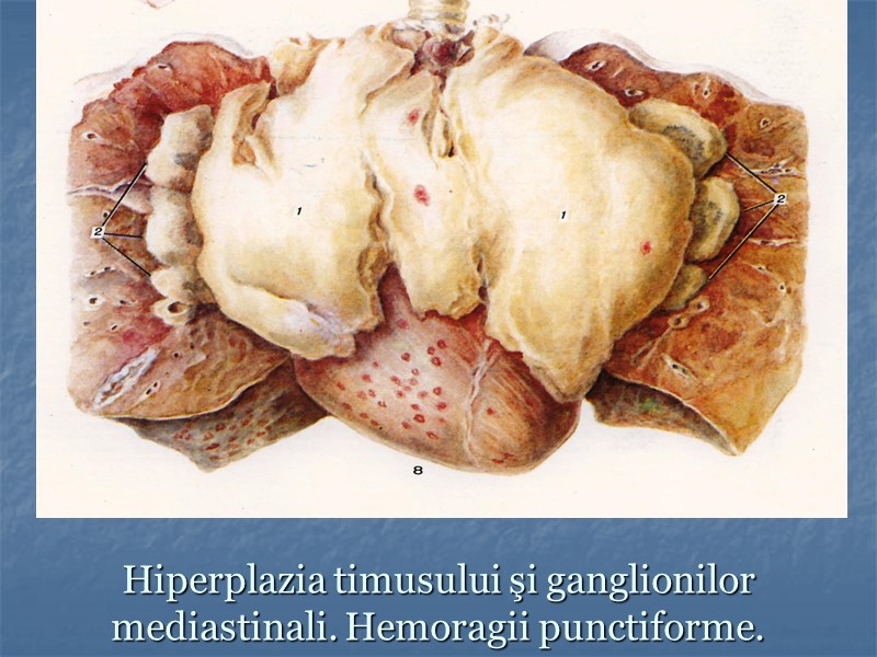 Hiperplazia timusului şi ganglionilor mediastinali. Hemoragii punctiforme.